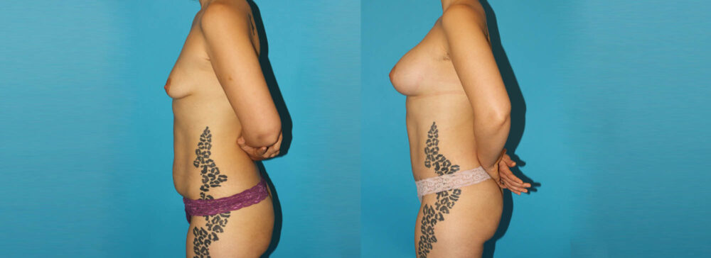 Post Bariatric Surgery (Massive Weight Loss) case #6777