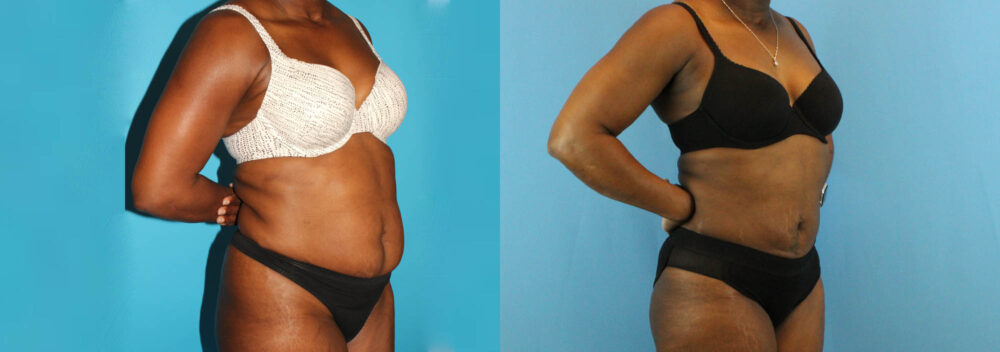 Liposuction case #5891