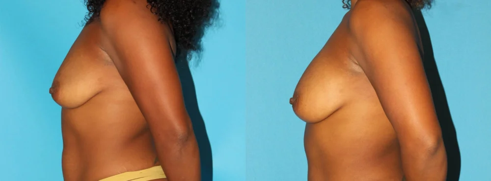 Fat Grafting to the Breast case #256147