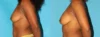 Fat Grafting to the Breast case #256147 slider thumbnail