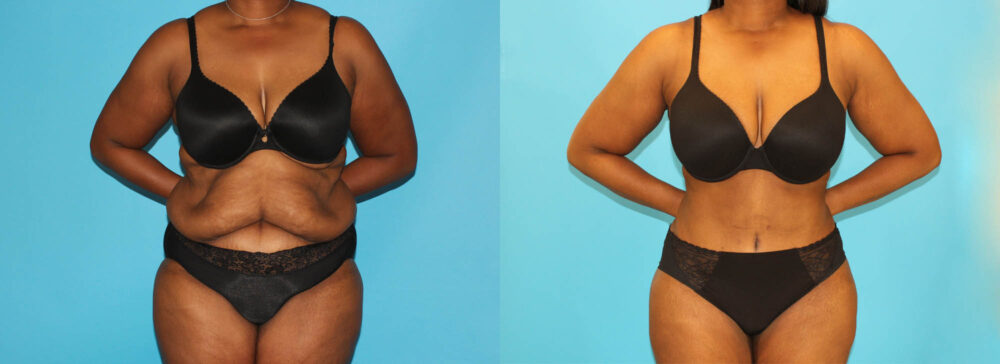 Post Bariatric Surgery (Massive Weight Loss) case #6779