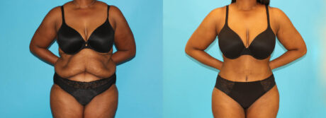 Post Bariatric Surgery (Massive Weight Loss) case #6779