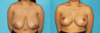 Breast Reduction case #7962 slider thumbnail