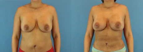 Fat Grafting to the Breast case #256167