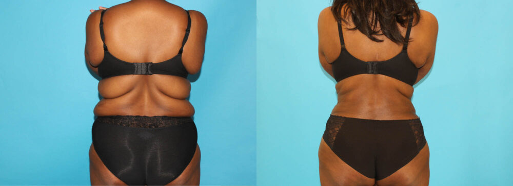 Post Bariatric Surgery (Massive Weight Loss) case #6779