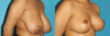 Breast Reduction case #7962 slider thumbnail