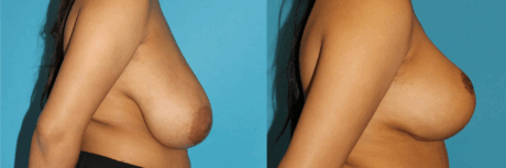 Breast Reduction case #7962