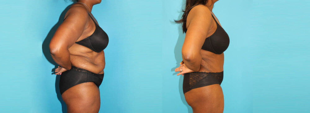 Post Bariatric Surgery (Massive Weight Loss) case #6779