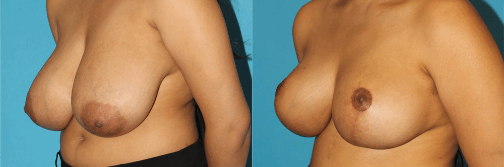 Breast Reduction case #7962
