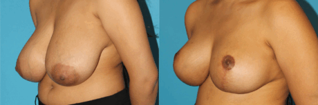 Breast Reduction case #7962