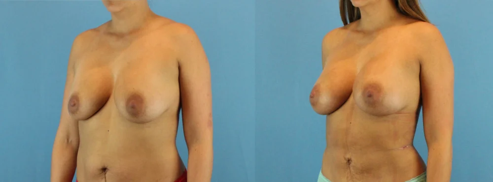 Fat Grafting to the Breast case #256167