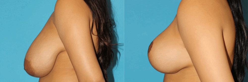 Breast Reduction case #7962