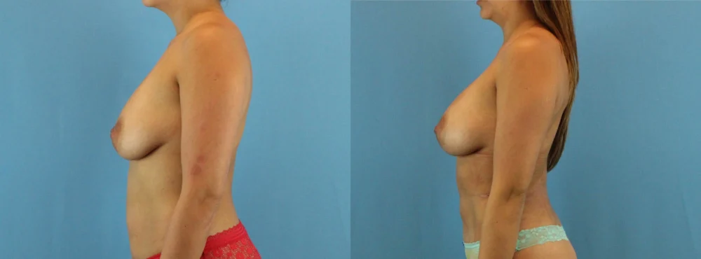 Fat Grafting to the Breast case #256167