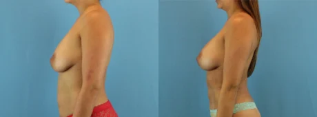 Fat Grafting to the Breast case #256167