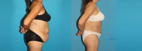 Post Bariatric Surgery (Massive Weight Loss) case #6778