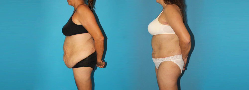 Post Bariatric Surgery (Massive Weight Loss) case #6778