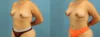 Fat Grafting to the Breast case #256201 slider thumbnail