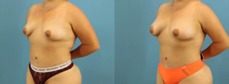 Fat Grafting to the Breast case #256201