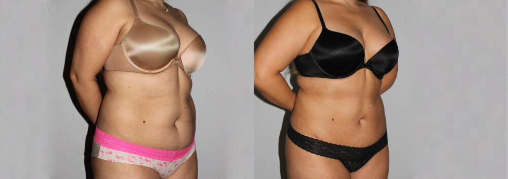 Liposuction case #5828