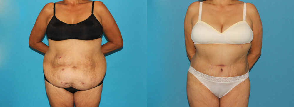 Post Bariatric Surgery (Massive Weight Loss) case #6778