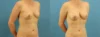 Fat Grafting to the Breast case #256188 slider thumbnail