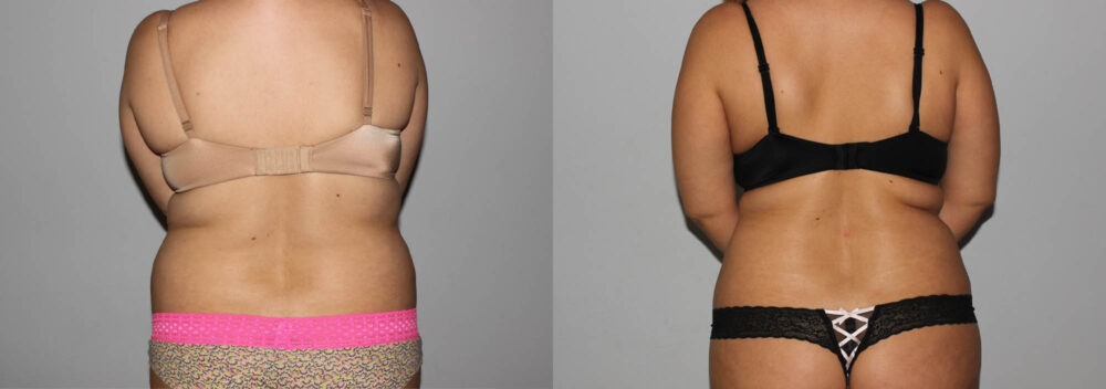 Liposuction case #5828