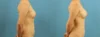 Fat Grafting to the Breast case #256188 slider thumbnail