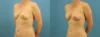Fat Grafting to the Breast case #256188 slider thumbnail