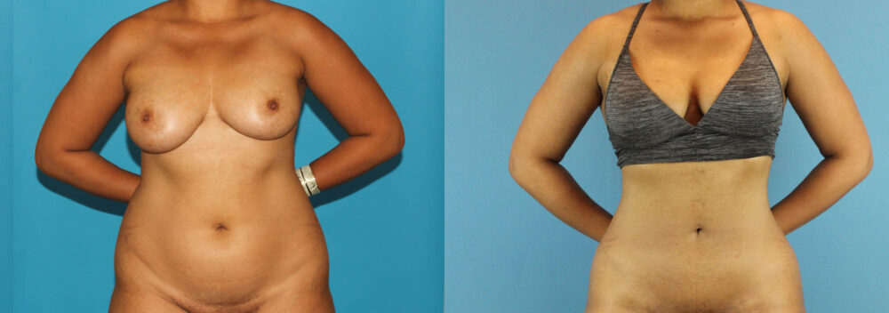 Liposuction case #5892