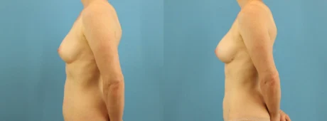 Fat Grafting to the Breast case #256188