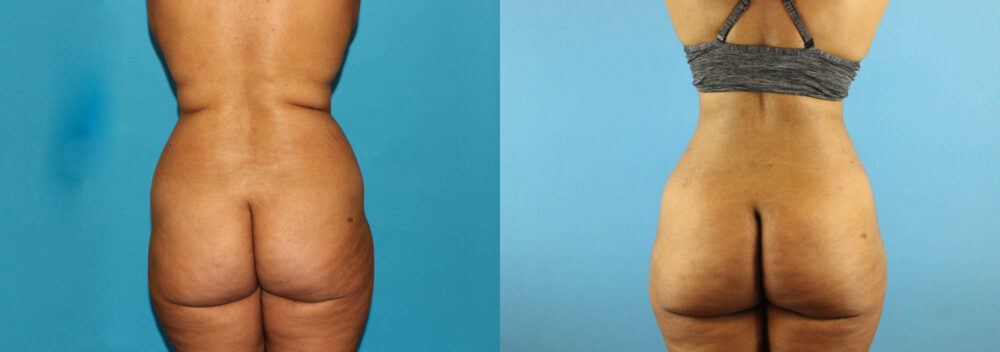 Liposuction case #5892