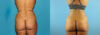 Liposuction case #5892 slider thumbnail