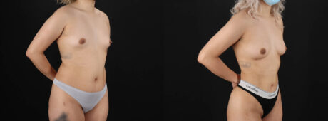 Fat Grafting to the Breast case #8036