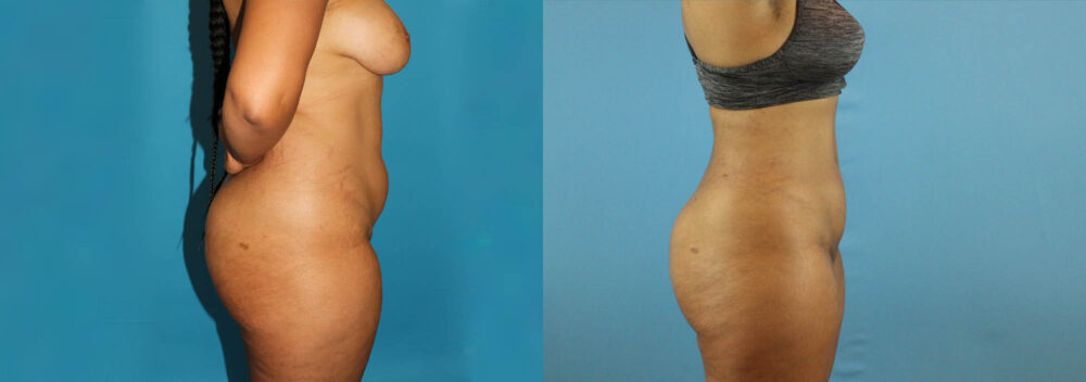 Liposuction case #5892