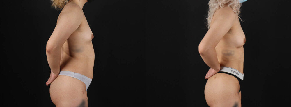 Fat Grafting to the Breast case #8036