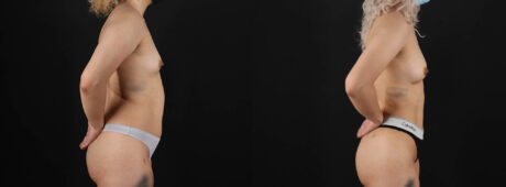 Fat Grafting to the Breast case #8036