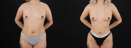 Fat Grafting to the Breast case #8036