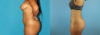 Liposuction case #5892 slider thumbnail