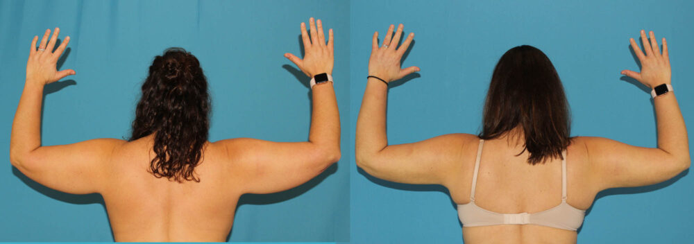 Liposuction case #5895