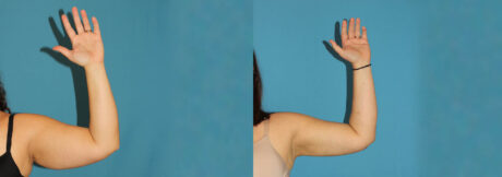 Liposuction case #5895