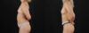Fat Grafting to the Breast case #8036 slider thumbnail