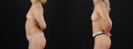 Fat Grafting to the Breast case #8036