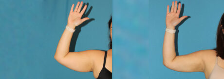 Liposuction case #5895