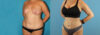 Liposuction case #5964 slider thumbnail