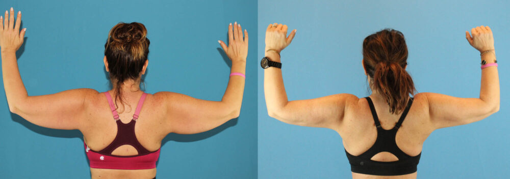 Liposuction case #5963