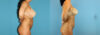 Liposuction case #5962 slider thumbnail
