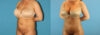 Liposuction case #5962 slider thumbnail