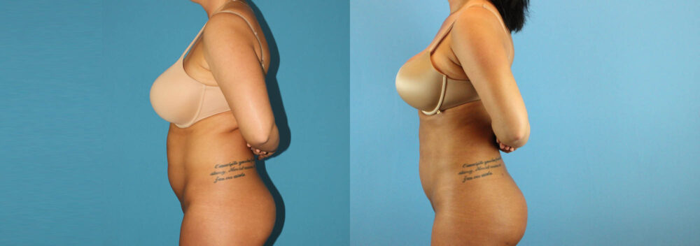Liposuction case #5962