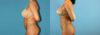 Liposuction case #5962 slider thumbnail