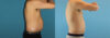 Liposuction case #5965 slider thumbnail